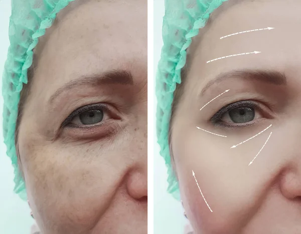 woman face wrinkles before and after procedures, arrow