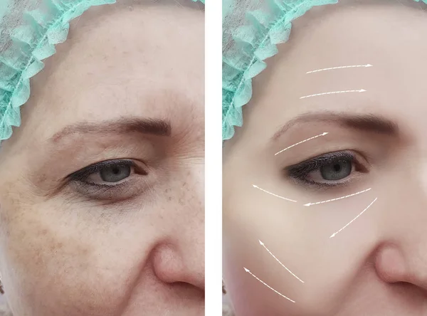 Woman Face Wrinkles Procedures Arrow — Stock Photo, Image