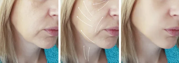 Woman Face Wrinkles Procedures Arrow — Stock Photo, Image