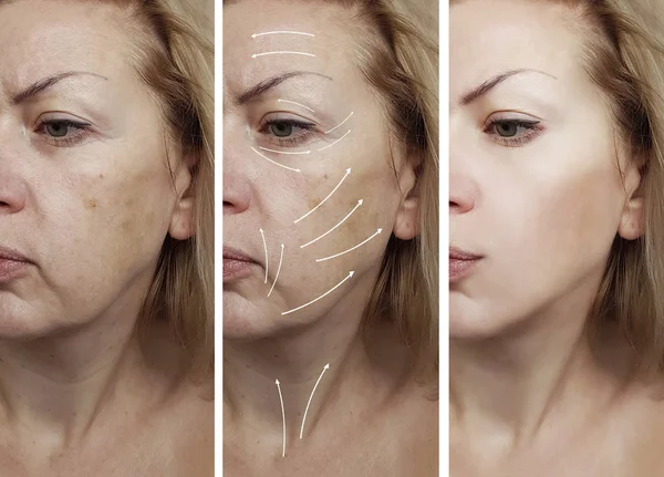 Wanita Wajah Keriput Sebelum Dan Setelah Prosedur Panah — Stok Foto