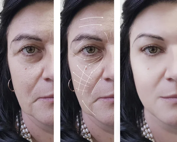 Arrugas Cara Mujer Antes Después Los Procedimientos Flecha — Foto de Stock