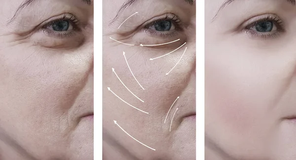 Γυναίκα Πρόσωπο Ρυτίδες Πριν Και Μετά Από Διαδικασίες Βέλος — Φωτογραφία Αρχείου