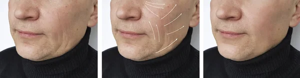 Man Wrinkles Face Procedures Arrow — Stock Photo, Image
