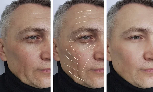 Hombre Arrugas Cara Antes Después Los Procedimientos Flecha — Foto de Stock