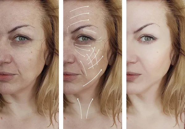 Wanita Wajah Keriput Sebelum Dan Setelah Prosedur Panah — Stok Foto