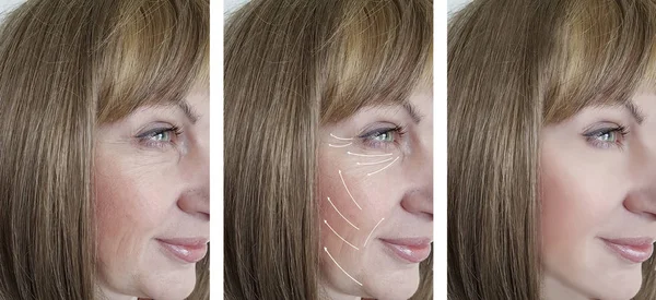 Mujer Arrugas Faciales Corrección Antes Después Procedimientos Flecha —  Fotos de Stock