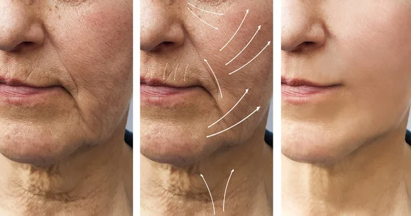 Woman Elderly Facial Wrinkles Correction Procedures Arrow — Stock Photo, Image