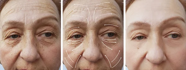 Mujer Anciano Facial Arrugas Corrección Antes Después Procedimientos Flecha — Foto de Stock