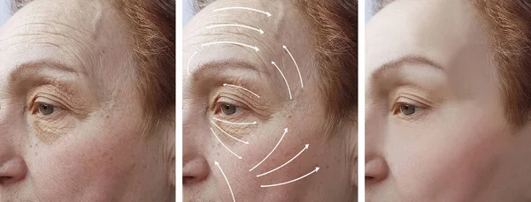 Mujer Anciano Facial Arrugas Corrección Antes Después Procedimientos Flecha — Foto de Stock