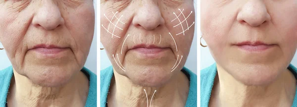 老年妇女面部皱纹矫正前后程序箭头 — 图库照片