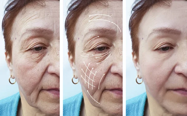 Cara Anciana Mujer Arrugas Corrección Antes Después Procedimientos Flecha — Foto de Stock