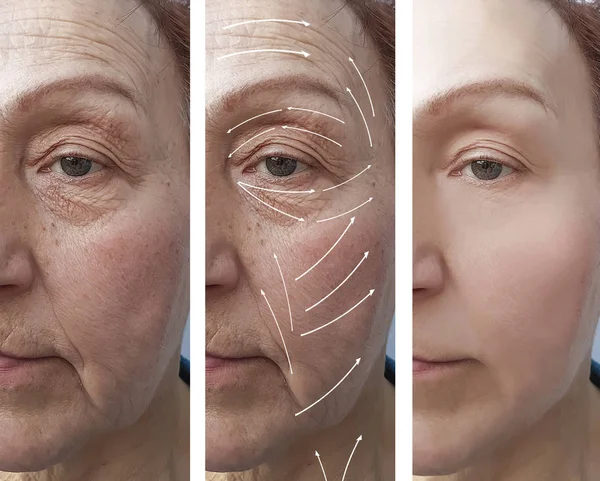 Face Elderly Woman Wrinkles Correction Procedures Arrow — Stock Photo, Image