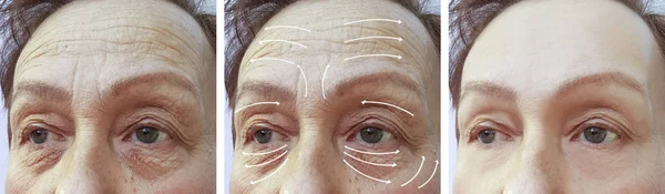 Faccia Donna Anziana Rughe Correzione Prima Dopo Procedure Freccia — Foto Stock
