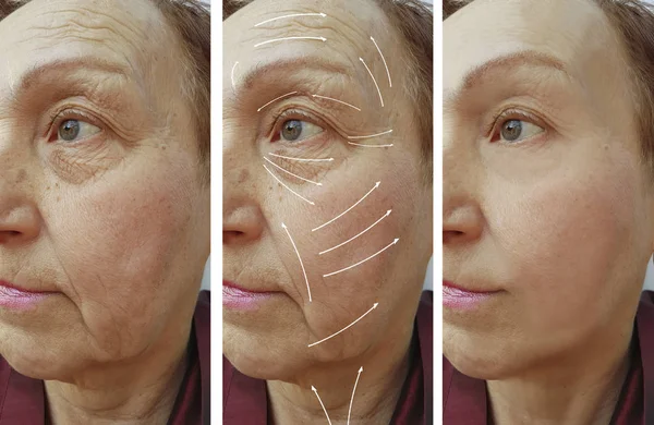 Face Elderly Woman Wrinkles Correction Procedures Arrow — Stock Photo, Image