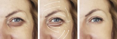 kadın yüz kırışıklıkları düzeltme öncesi ve sonrası yordamları, ok