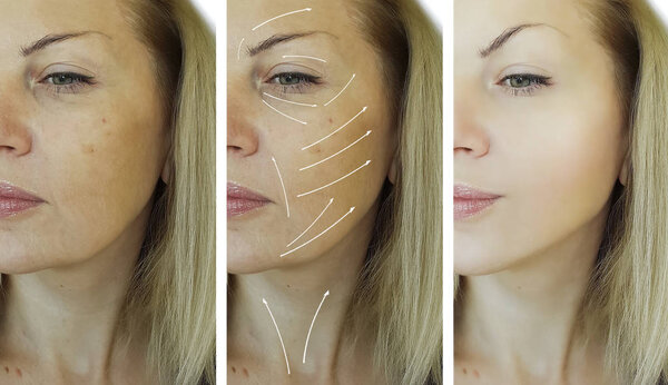 face woman wrinkles correction before and after procedures, arrow