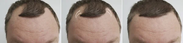 Männliche Glatze Vor Und Nach Der Behandlung — Stockfoto