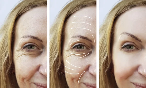 Mujer Arrugas Faciales Corrección Antes Después Procedimientos Flecha — Foto de Stock