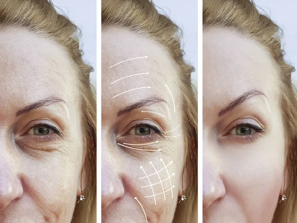 Woman Facial Wrinkles Correction Procedures Arrow — Stock Photo, Image