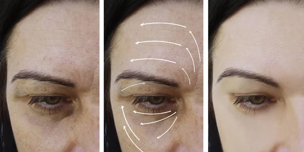 Femeie Riduri Faciale Corectarea Înainte După Proceduri Săgeată — Fotografie, imagine de stoc