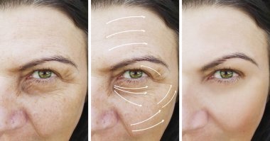 kadın yüz kırışıklıkları düzeltme öncesi ve sonrası yordamları, ok