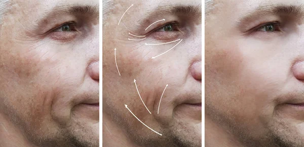 Erkek Yüz Kırışıklıklar Öncesi Sonrası Düzeltme — Stok fotoğraf