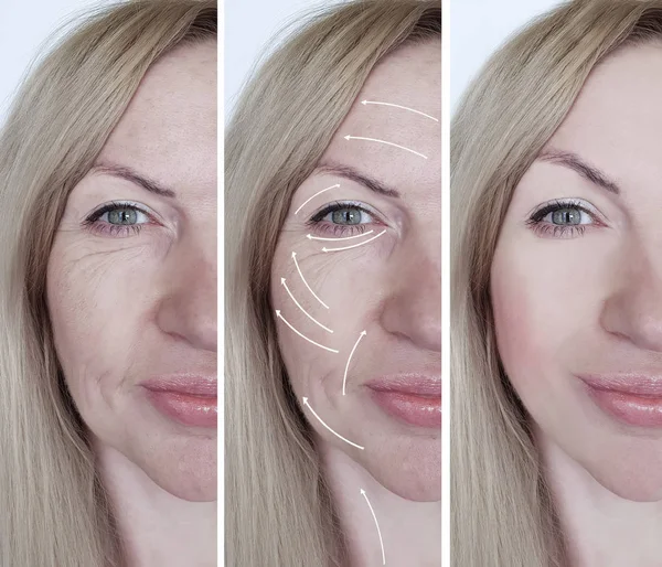 Woman Face Wrinkles Correction Procedures Arrow — Stock Photo, Image