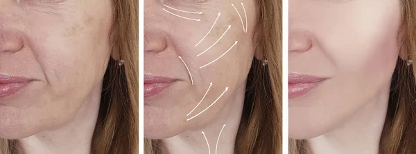 woman face wrinkles correction before and after procedures, arrow