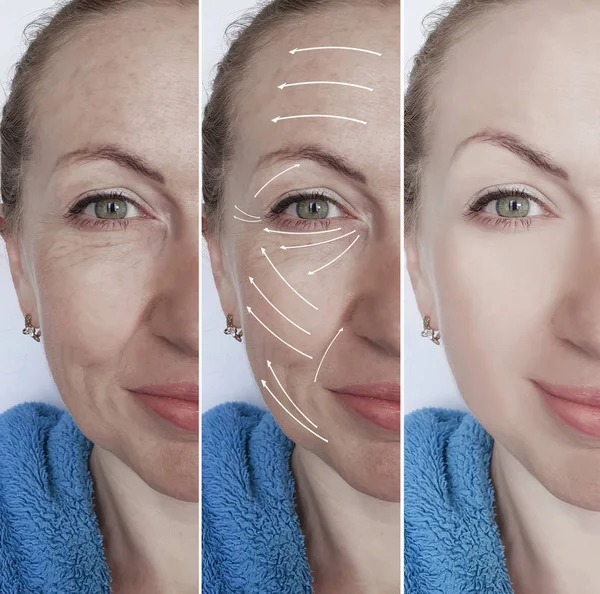 Woman Face Wrinkles Correction Procedures Arrow — Stock Photo, Image