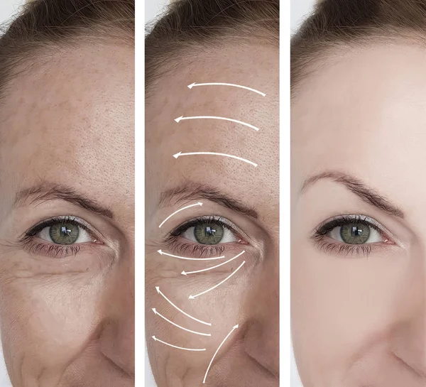 Woman Face Wrinkles Correction Procedures Arrow — Stock Photo, Image