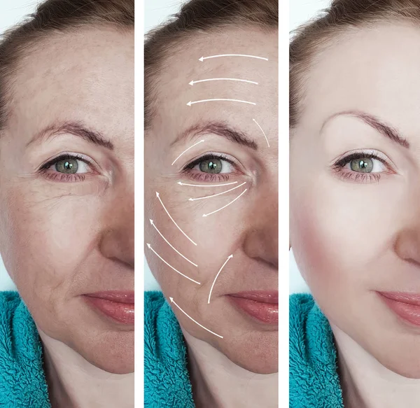 Woman Face Wrinkles Correction Procedures Arrow — Stock Photo, Image