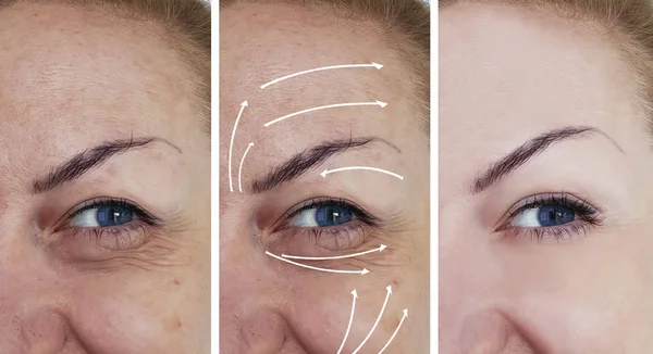 Woman Wrinkles Correction Treatments Arrow — Stock Photo, Image