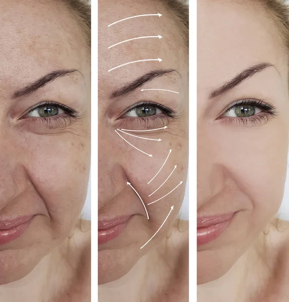 Woman Wrinkles Correction Treatments Arrow — Stock Photo, Image