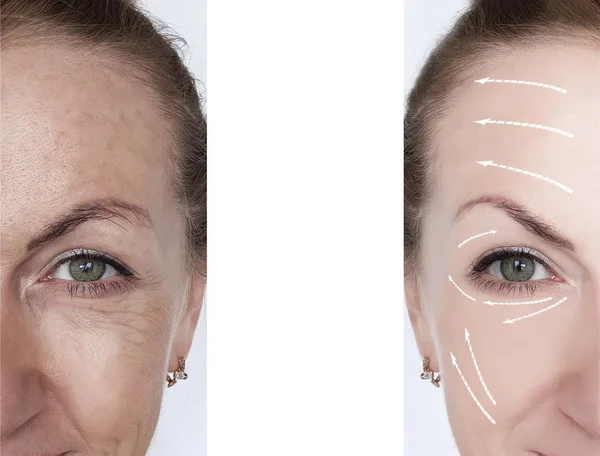 Woman Wrinkles Correction Treatments Arrow — Stock Photo, Image