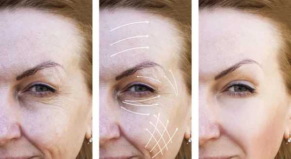 Woman Wrinkles Correction Treatments Arrow — Stock Photo, Image