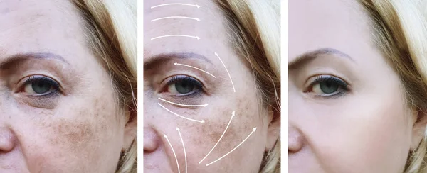 Woman Wrinkles Correction Procedures Arrow Pigmentation — Stock Photo, Image