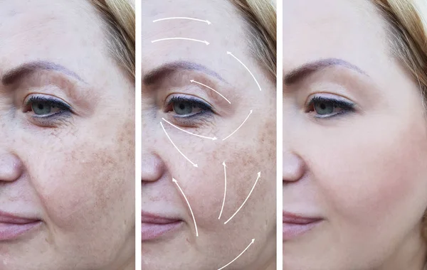 Woman Wrinkles Correction Procedures Arrow Pigmentation — Stock Photo, Image