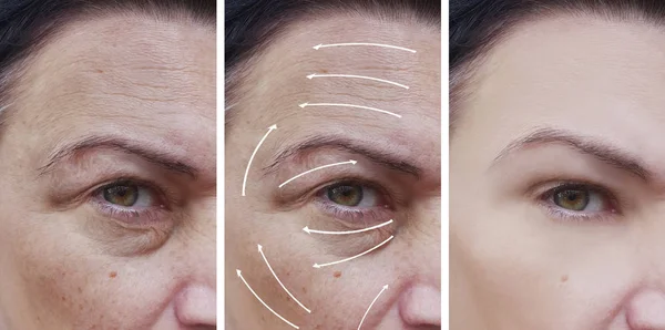 Woman Face Wrinkles Correction Procedures Arrow — Stock Photo, Image