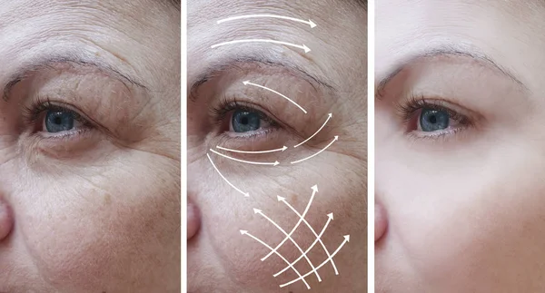 Mujer Cara Arrugas Corrección Antes Después Los Procedimientos Flecha — Foto de Stock
