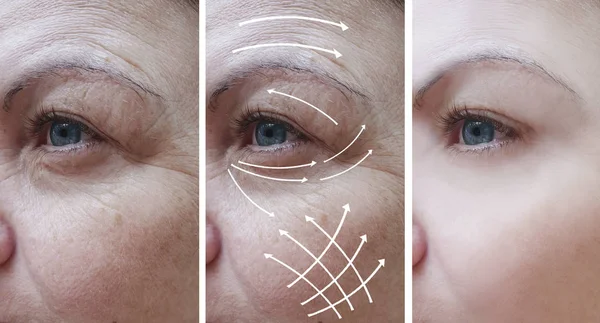 woman face wrinkles correction before and after procedures, arrow