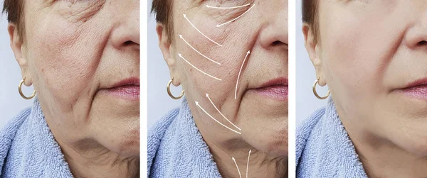 Donna Anziana Correzione Delle Rughe Facciali Prima Dopo Procedure Freccia — Foto Stock