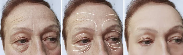 高齢者の女性は 顔のしわ補正の手順の前後に矢印 — ストック写真