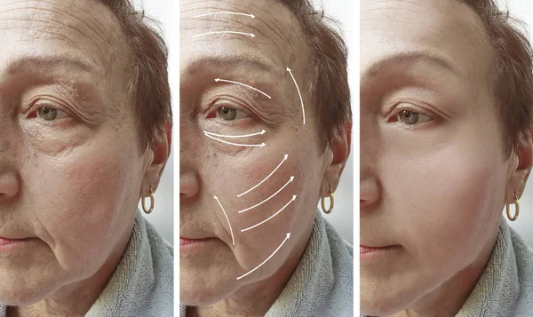 Пожилая Женщина Коррекция Морщин Лица После Процедур Стрела — стоковое фото