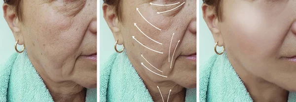 Äldre Kvinna Ansiktsbehandling Rynkor Korrigering Före Och Efter Förfaranden Pil — Stockfoto