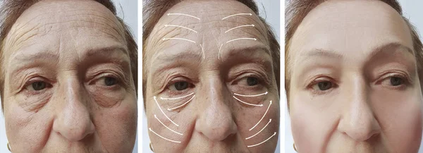 老年妇女 面部皱纹矫正前后的程序 — 图库照片