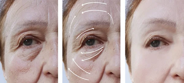 Mulher Idosa Correção Rugas Faciais Antes Depois Dos Procedimentos Seta — Fotografia de Stock