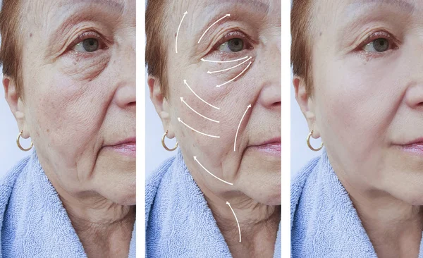Пожилая Женщина Коррекция Морщин Лица После Процедур Стрела — стоковое фото