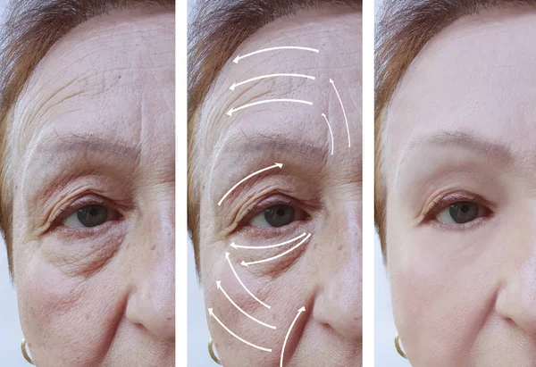 Elderly Woman Facial Wrinkles Correction Procedures Arrow — Stock Photo, Image