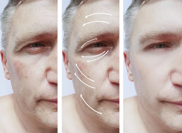 Manusia Keriput Wajah Koreksi Sebelum Dan Setelah Prosedur — Stok Foto