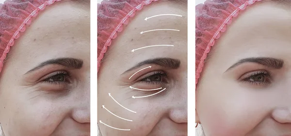 Mujer Arrugas Cara Corrección Antes Después Los Procedimientos Flecha —  Fotos de Stock